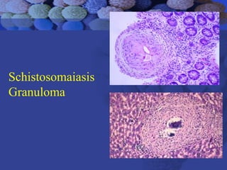 Schistosomaiasis
Granuloma
 