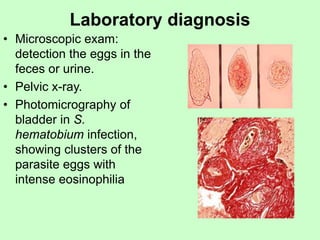 Laboratory diagnosis
• Microscopic exam:
detection the eggs in the
feces or urine.
• Pelvic x-ray.
• Photomicrography of
bladder in S.
hematobium infection,
showing clusters of the
parasite eggs with
intense eosinophilia
 
