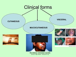 Clinical forms
VISCERAL
MUCOCUTANEOUS
CUTANEOUS
 