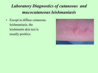 Laboratory Diagnostics of cutaneous and
mucocutaneous leishmaniasis
• Except in diffuse cutaneous
leishmaniasis, the
leishmanin skin test is
usually positive.
 