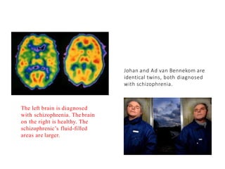 The left brain is diagnosed
with schizophrenia. The brain
on the right is healthy. The
schizophrenic’s fluid-filled
areas are larger.
Johan and Ad van Bennekom are
identical twins, both diagnosed
with schizophrenia.
 