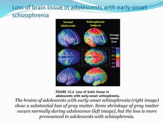 Loss of brain tissue in adolescents with early-onset
schizophrenia
The brains of adolescents with early-onset schizophrenia (right image)
show a substantial loss of gray matter. Some shrinkage of gray matter
occurs normally during adolescence (left image), but the loss is more
pronounced in adolescents with schizophrenia.
 