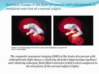 Structural changes in the brain of a person with schizophrenia as
compared with that of a normal subject
The magnetic resonance imaging (MRI) of the brain of a person with
schizophrenia (left) shows a relatively shrunken hippocampus (yellow)
and relatively enlarged, fluid-filled ventricles (white) when compared to
the structures of the normal subject (right).
 