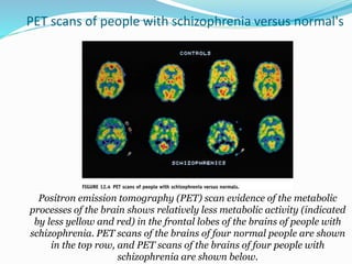 PET scans of people with schizophrenia versus normal's
Positron emission tomography (PET) scan evidence of the metabolic
processes of the brain shows relatively less metabolic activity (indicated
by less yellow and red) in the frontal lobes of the brains of people with
schizophrenia. PET scans of the brains of four normal people are shown
in the top row, and PET scans of the brains of four people with
schizophrenia are shown below.
 