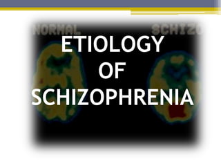 ETIOLOGY
OF
SCHIZOPHRENIA
 