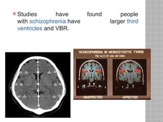  Studies have found people
with schizophrenia have larger third
ventricles and VBR.
 