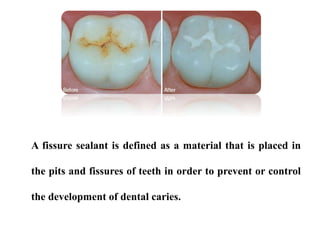 A fissure sealant is defined as a material that is placed in
the pits and fissures of teeth in order to prevent or control
the development of dental caries.
 