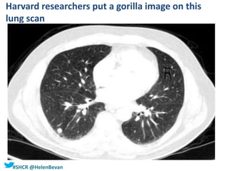 #SHCR @HelenBevan
Harvard researchers put a gorilla image on this
lung scan
 