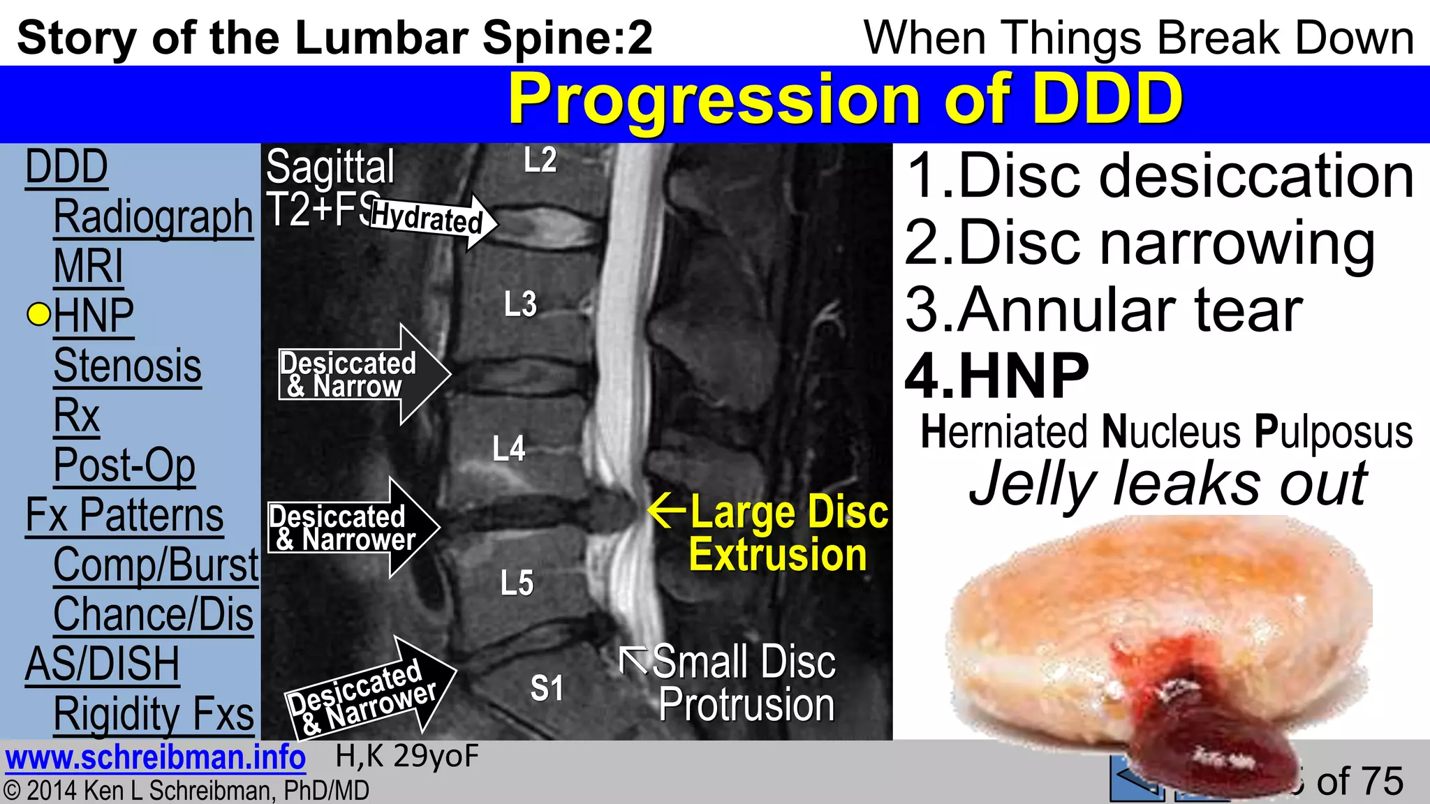 Story of the Lumbar Spine 2 When Things Break Down | PPSX