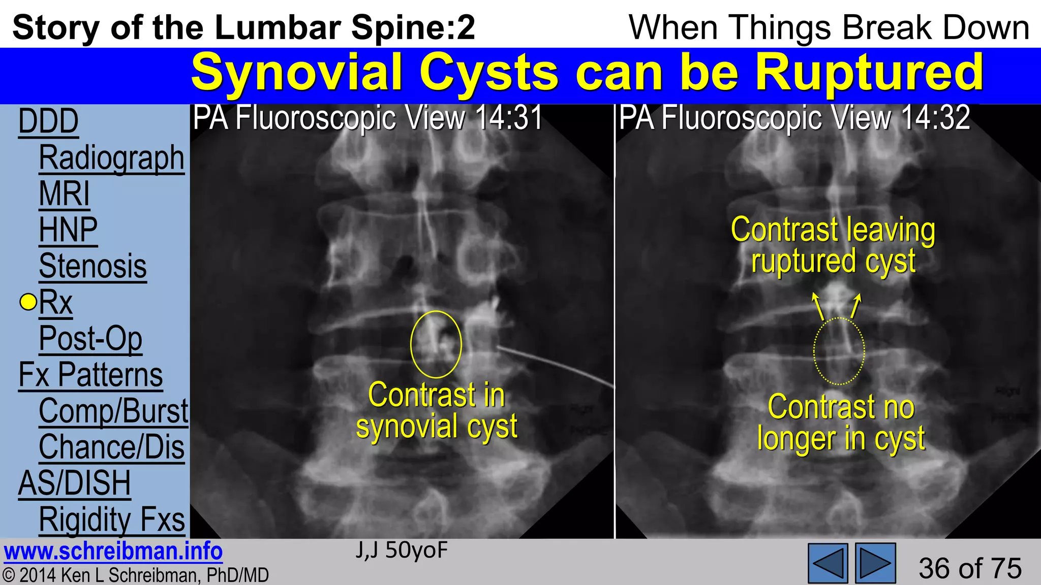 Story of the Lumbar Spine 2 When Things Break Down | PPSX