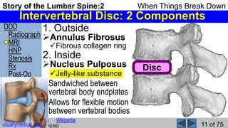 Story of the Lumbar Spine 2 When Things Break Down | PPSX