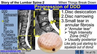 Story of the Lumbar Spine 2 When Things Break Down | PPSX