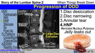 Story of the Lumbar Spine 2 When Things Break Down | PPSX
