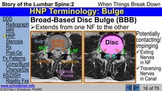 Story of the Lumbar Spine 2 When Things Break Down | PPSX
