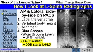 Story of the Lumbar Spine 2 When Things Break Down | PPSX