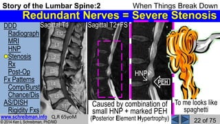 Story of the Lumbar Spine 2 When Things Break Down | PPSX