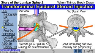 Story of the Lumbar Spine 2 When Things Break Down | PPSX