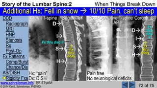 Story of the Lumbar Spine 2 When Things Break Down | PPSX