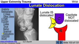 Upper Extremity Trauma Wrist complete MSK Radiology Lecture | PPSX