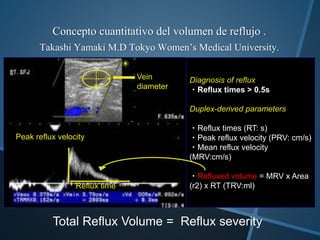 Concepto cuantitativo del volumen de reflujo .
Takashi Yamaki M.D Tokyo Women’s Medical University.
Diagnosis of reflux
・Reflux times > 0.5s
Duplex-derived parameters
・Reflux times (RT: s)
・Peak reflux velocity (PRV: cm/s)
・Mean reflux velocity
(MRV:cm/s)
・Refluxed volume = MRV x Area
(r2) x RT (TRV:ml)Reflux time
Peak reflux velocity
Vein
diameter
.
Total Reflux Volume = Reflux severity
 