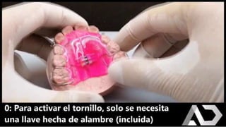 SCHWARTZ (TORNILLO DE EXPANSIÓN) lista.pptx