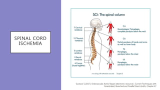 SPINAL CORD
ISCHEMIA
Gustavo S.(2017). Endovascular Aortic Repair [electronic resource] : Current Techniques with
Fenestrated, Branched and Parallel Stent-Grafts. Chapter 47
 