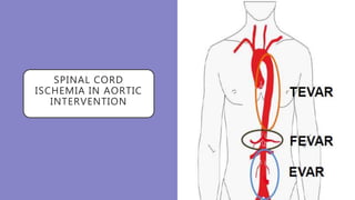SPINAL CORD
ISCHEMIA IN AORTIC
INTERVENTION
 
