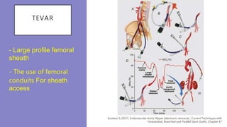 TEVAR
- Large profile femoral
sheath
- The use of femoral
conduits For sheath
access
Gustavo S.(2017). Endovascular Aortic Repair [electronic resource] : Current Techniques with
Fenestrated, Branched and Parallel Stent-Grafts. Chapter 47
 