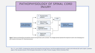 PATHOPHYSIOLOGY OF SPINAL CORD
INJURY
Etz, C. D., et al. (2015). Contemporary spinal cord protection during thoracic and thoracoabdominal aortic surgery and endovascular aortic repair: a position
paper of the vascular domain of the European Association for Cardio-Thoracic Surgery, Oxford University Press.
 