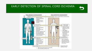 EARLY DETECTION OF SPINAL CORD ISCHEMIA
 