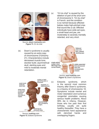 289
(a)	 “Cri du chat” is caused by the
deletion of part of the short arm
of chromosome 5. “Cri du chat”
is French, and the condition
is so named because affected
babies make high-pitched cries
that sound like a cat. Affected
individuals have wide-set eyes,
a small head and jaw, are
moderately to severely mentally
retarded, and very short.
Source: player.mashpedia.com
Figure 11. Cri du chat
(b)	 Down’s syndrome is usually
caused by an extra copy
of chromosome 21(trisomy
21). Characteristics include
decreased muscle tone,
stockier build, asymmetrical
skull, slanting eyes and
mild to moderate mental
retardation.
Source: www.healthtap.com
Figure 12. Down’s Syndrome
(c)	 Edwards syndrome, which
is the second most common
trisomy after Down’s syndrome,
is a trisomy of chromosome 18.
Symptoms include mental and
motor retardation and numerous
congenital anomalies causing
serious health problems. About
99% die in infancy. However,
those who live past their first
birthday, usually are quite
healthy thereafter. They have a
characteristic hand appearance
with clenched hands and
overlapping fingers.
Source: healthtap.com
Figure 13. Edward Syndrome
flattened
nose and
face, upward
slanting eyes
widely seperated
first and second
toes and
increased skin
creases
single palmer
crease, short
fifth finger that
curves inward
small mouth,
small jaw,
short neck
shield chest,
or short and
prominent
sternum;
and wide-set
nipples
occiput, or back
part of the skull, is
prominent
dysplastic, or
malformed ears
clenched hands
with overlapping
fingers
flexed big toe;
prominent heels
 