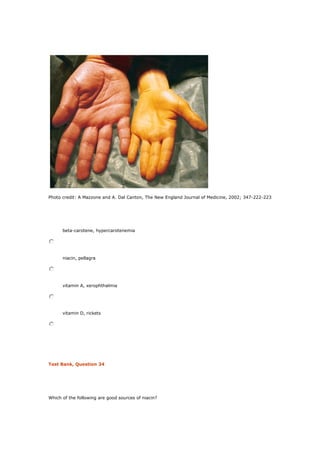 Photo credit: A Mazzone and A. Dal Canton, The New England Journal of Medicine, 2002; 347-222-223
beta-carotene, hypercarotenemia
niacin, pellagra
vitamin A, xerophthalmia
vitamin D, rickets
Test Bank, Question 34
Which of the following are good sources of niacin?
 