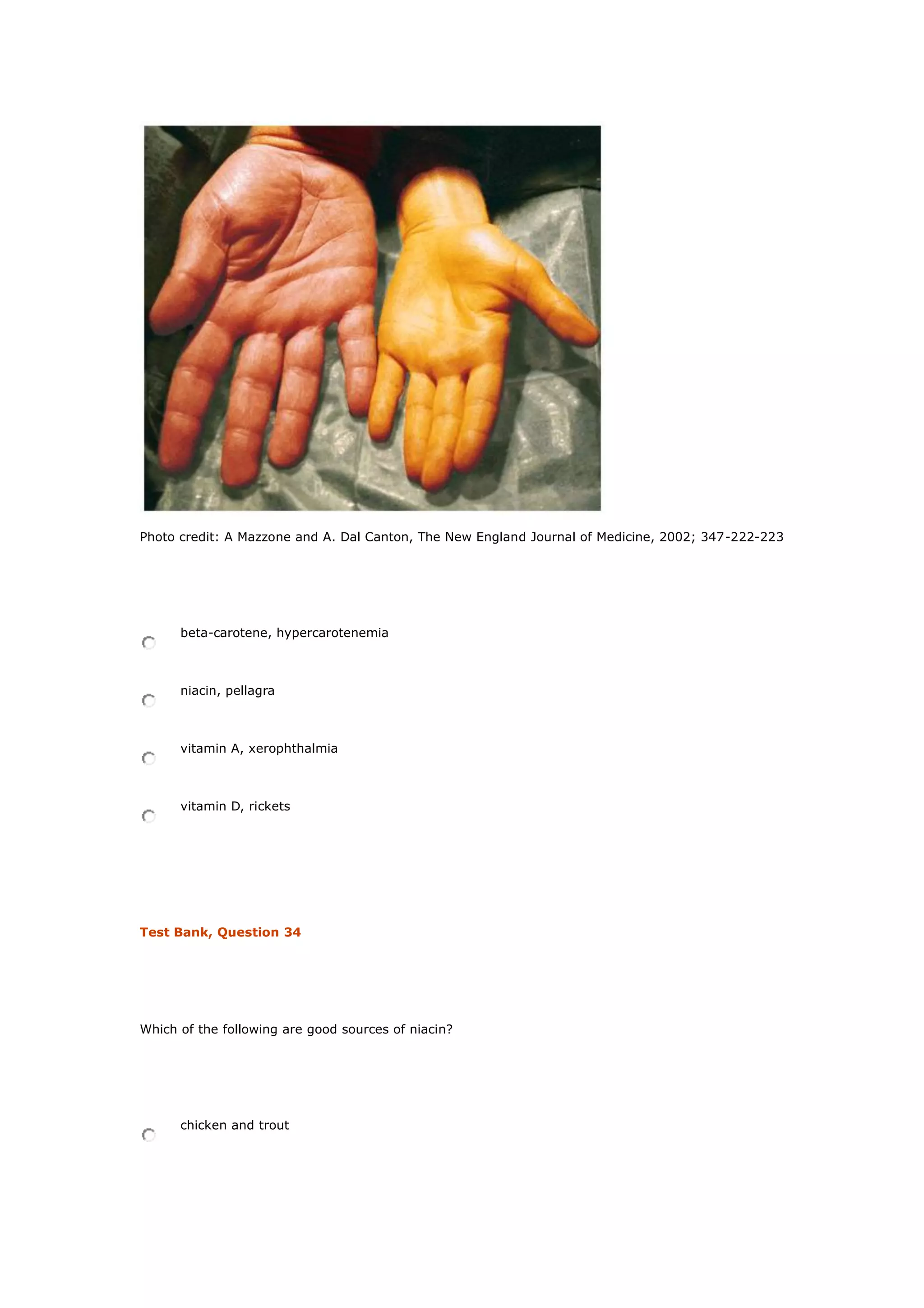 Photo credit: A Mazzone and A. Dal Canton, The New England Journal of Medicine, 2002; 347-222-223
beta-carotene, hypercarotenemia
niacin, pellagra
vitamin A, xerophthalmia
vitamin D, rickets
Test Bank, Question 34
Which of the following are good sources of niacin?
chicken and trout
 