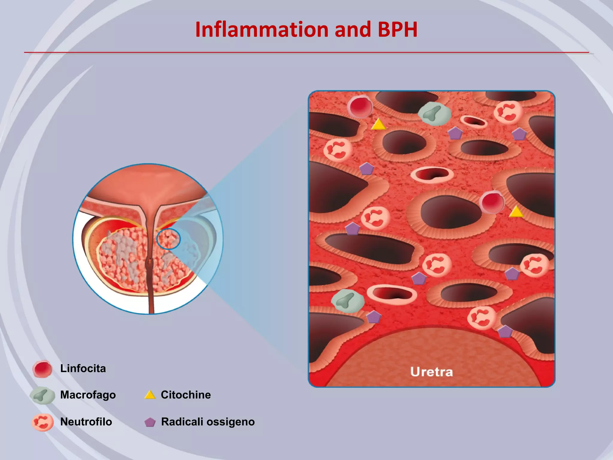 Inflammation and BPH




Linfocita

Macrofago    Citochine

Neutrofilo   Radicali ossigeno
 