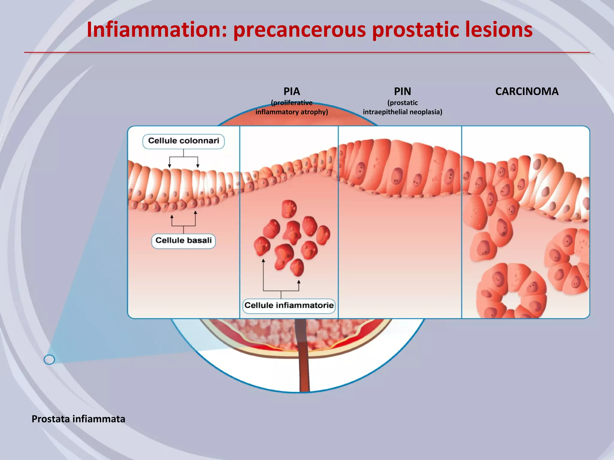 Infiammation: precancerous prostatic lesions

                                   PIA                       PIN                CARCINOMA
                                (proliferative             (prostatic
                           inflammatory atrophy)   intraepithelial neoplasia)




Prostata infiammata
 