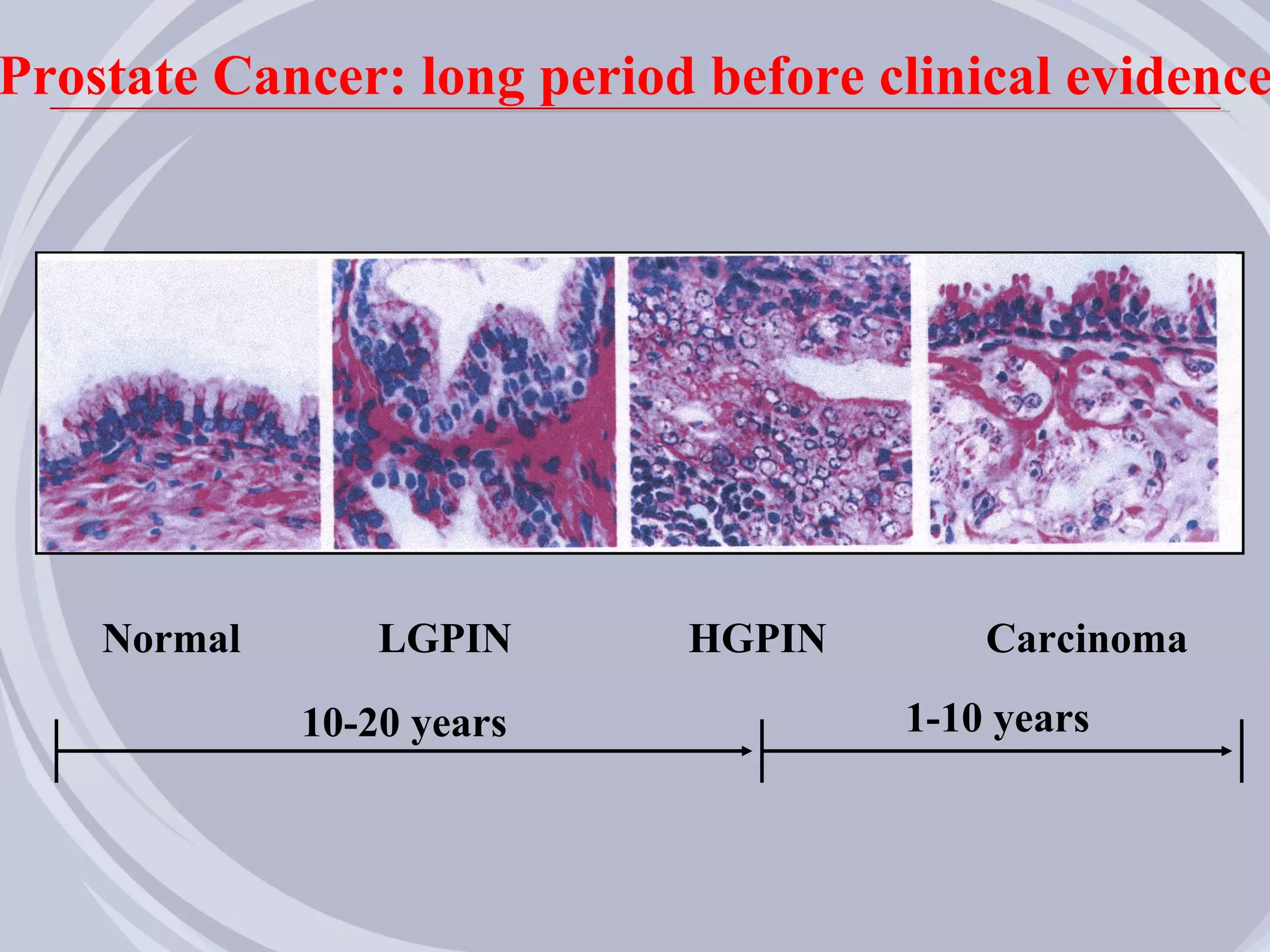 Prostate Cancer: long period before clinical evidence




    Normal       LGPIN      HGPIN        Carcinoma
             10-20 years             1-10 years
 