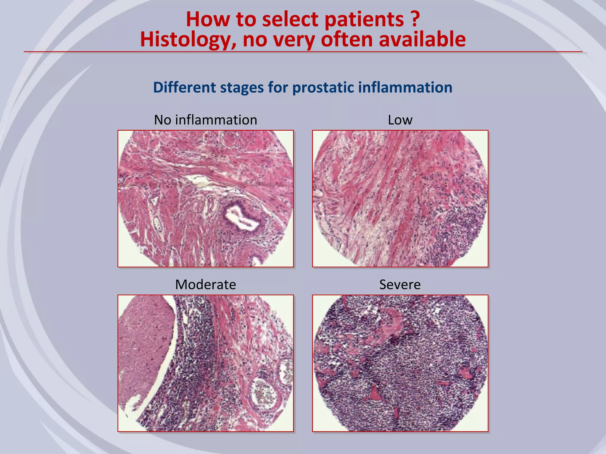 How to select patients ?
Histology, no very often available
 Different stages for prostatic inflammation
 No inflammation                  Low




    Moderate                     Severe
 