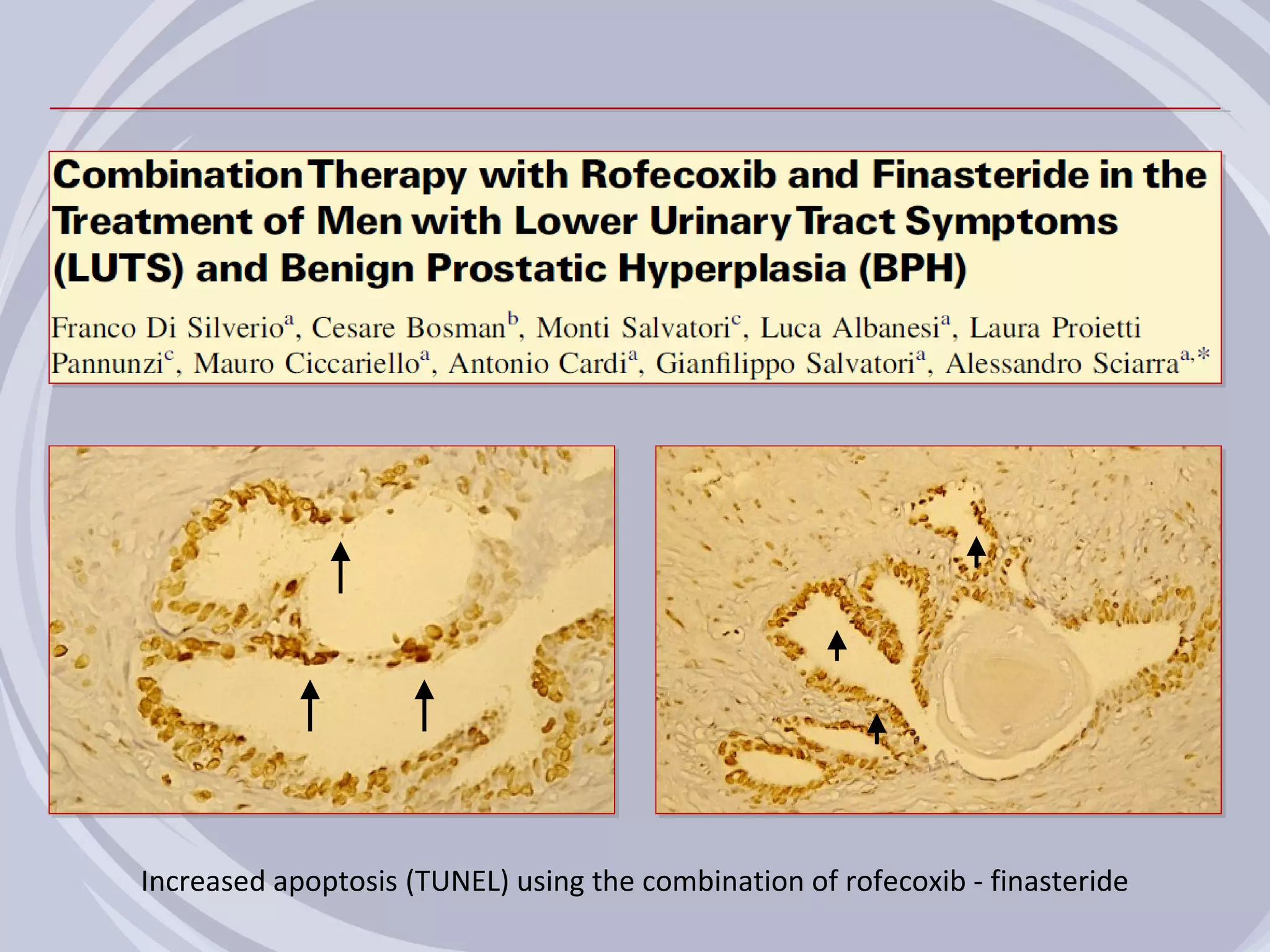 Increased apoptosis (TUNEL) using the combination of rofecoxib - finasteride
 
