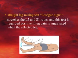 Lassague Sciatica | PPT