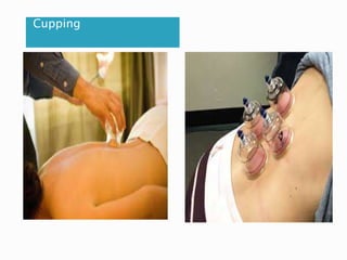 Cupping
 