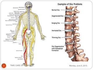 Sciatica | PPTX