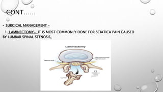 CONT……
• SURGICAL MANAGEMENT –
1. LAMINECTOMY- IT IS MOST COMMONLY DONE FOR SCIATICA PAIN CAUSED
BY LUMBAR SPINAL STENOSIS.
 
