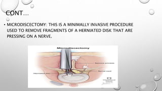 CONT…
• MICRODISCECTOMY: THIS IS A MINIMALLY INVASIVE PROCEDURE
USED TO REMOVE FRAGMENTS OF A HERNIATED DISK THAT ARE
PRESSING ON A NERVE.
 