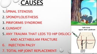CAUSES
1. SPINAL STENOSIS
2. SPONDYLOLISTHESIS
3. PIRIFORMIS SYNDROME
4. GUNSHOT
5. ANY TRAUMA THAT LEDS TO HIP DISLOCATION
AND ACETABULAM FRACTURE
6. INJECTION PALSY
7. TOTAL HIP JOINT REPLACEMENT
 