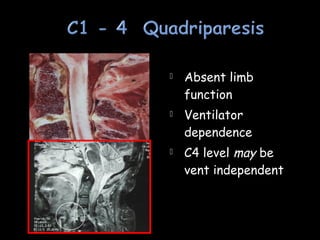  Absent limb
function
 Ventilator
dependence
 C4 level may be
vent independent
 