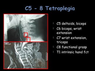  C5 deltoids, biceps
 C6 biceps, wrist
extension
 C7 wrist extension,
triceps
 C8 functional grasp
 T1 intrinsic hand fct
4
5
 