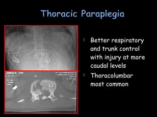  Better respiratory
and trunk control
with injury at more
caudal levels
 Thoracolumbar
most commonL1
T12
12
L1
 