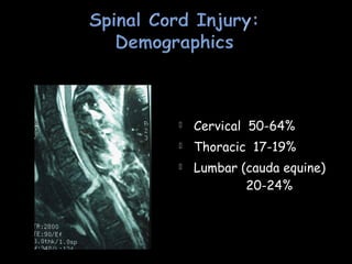  Cervical 50-64%
 Thoracic 17-19%
 Lumbar (cauda equine)
20-24%
 