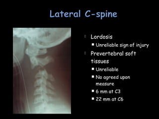  Lordosis
 Unreliable sign of injury
 Prevertebral soft
tissues
 Unreliable
 No agreed upon
measure
 6 mm at C3
 22 mm at C6
 