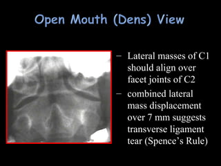 – Lateral masses of C1Lateral masses of C1
should align overshould align over
facet joints of C2facet joints of C2
– combined lateralcombined lateral
mass displacementmass displacement
over 7 mm suggestsover 7 mm suggests
transverse ligamenttransverse ligament
tear (Spence’s Rule)tear (Spence’s Rule)
 